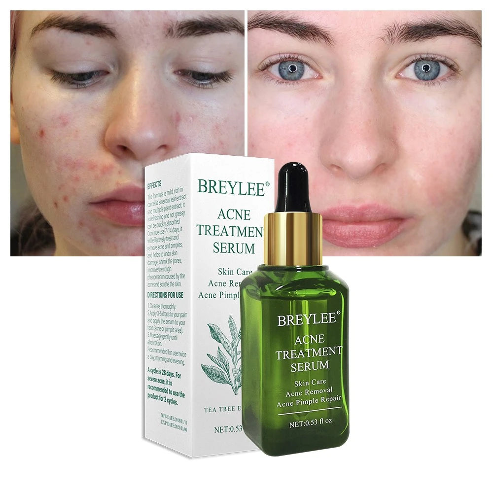 Sérum Facial Anti-Acné y Manchas | Tratamiento Reductor de Granos, Puntos Negros y Manchas | Piel Clara y Uniforme