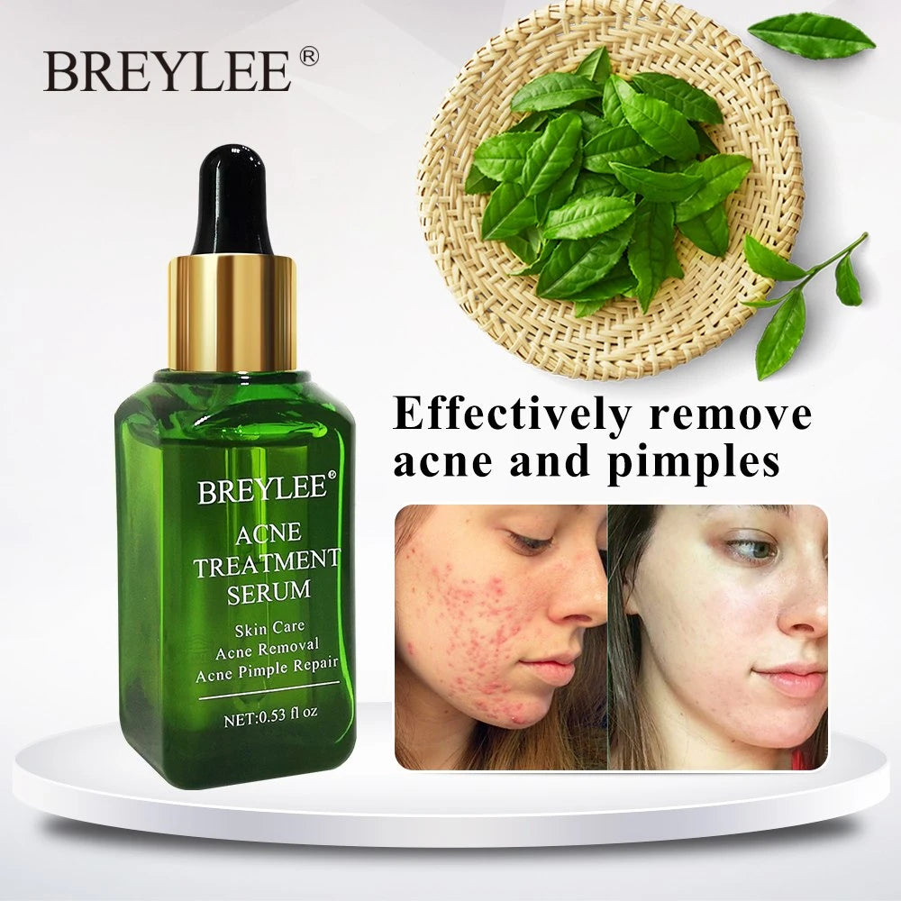 Sérum Facial Anti-Acné y Manchas | Tratamiento Reductor de Granos, Puntos Negros y Manchas | Piel Clara y Uniforme